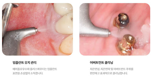 불당본점 서울비디치과의원, 천안 임플란트로 자신감 있는 웃음과 완벽한 치아를 찾아보세요
