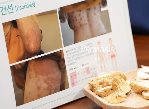 생기한의원 건선 정보, 팔꿈치와 무릎에 나타나는 피부 변화